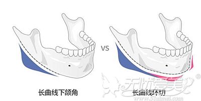 长曲线下颌角和普通下颌角手术的区别