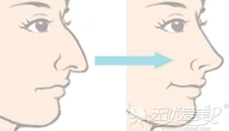 鹰钩鼻矫正是直接把鼻子突出的部位切除吗？