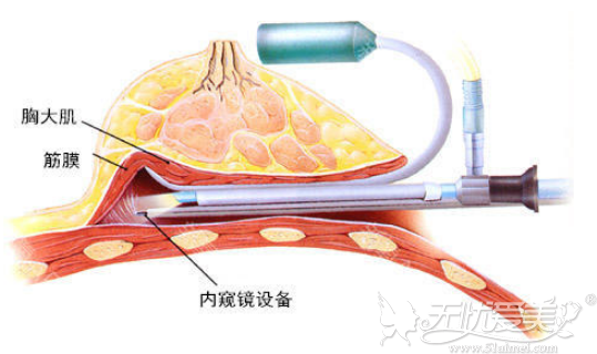 内窥镜隆胸手术过程