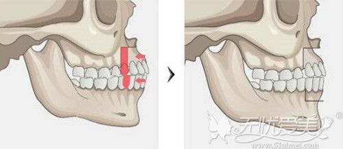 科普:双颚手术和面部轮廓整形手术的区别