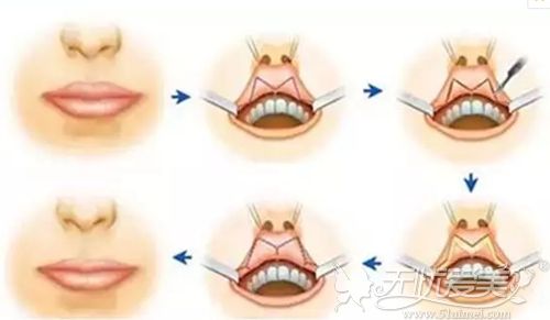 M唇手术的过程