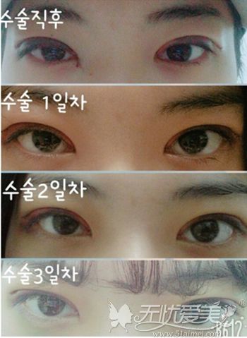在韩国做埋线双眼皮+开眼角手术后一周恢复