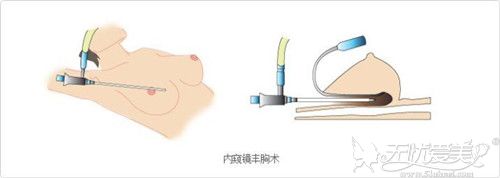 内窥镜隆胸手术
