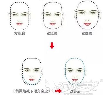 适合做下颌角手术的脸型类型