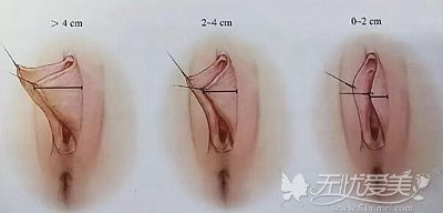 小阴唇肥大的不同程度