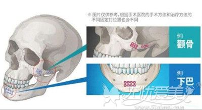 颧骨整形手术中钛钉的作用