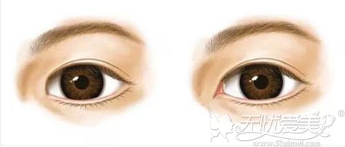 内眦赘皮不开眼角只割双眼皮手术效果就是做完后眼睛特圆