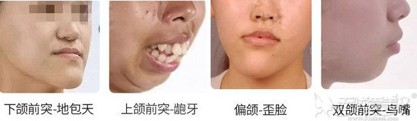 地包天、嘴巴前突可以做正颌手术矫正