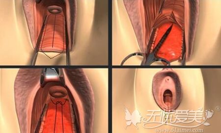 韩国后方膣圆盖术过程