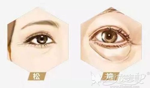 眼部皱纹较多想快速改善做提眉手术可以帮你轻松解决