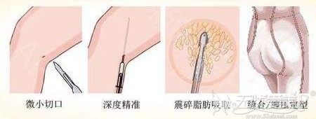 大腿吸脂手术的过程