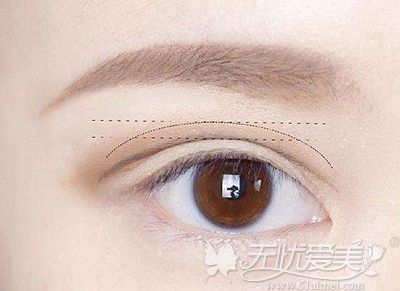 薛峰医生做双眼皮手术的优势