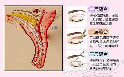 邱晓琳院长做双眼皮的技术优势