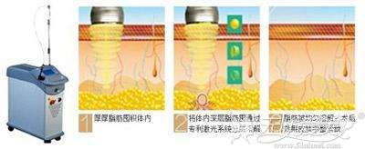 激光去眼袋的过程解析