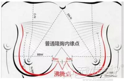 沸腾沟隆胸手术设计