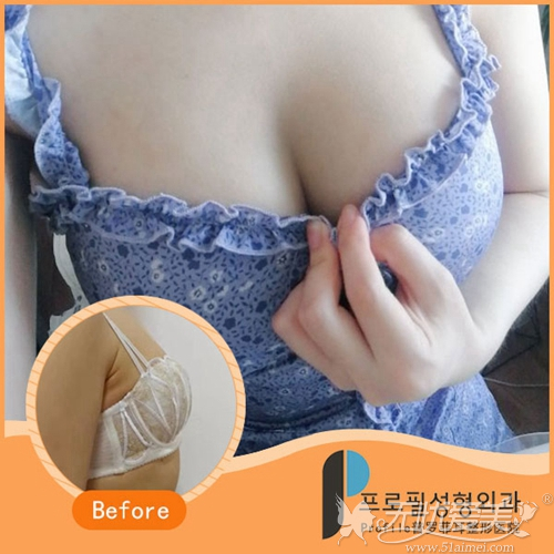 韩国假体隆胸手术案例