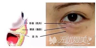 眶隔脂肪释放术就是外切后将眼袋处多余脂肪填充到泪沟
