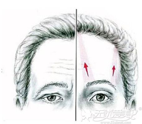 做完提眉手术后眉与眼间距变得很近多久能自行恢复?