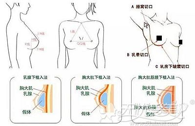王锐医生做假体隆胸的技术优势