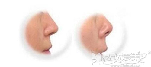 正常鼻子和鼻子挛缩的区别