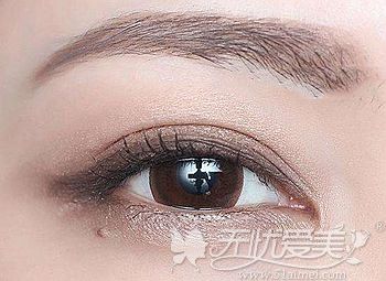 阳赞军主任做双眼皮的技术优势