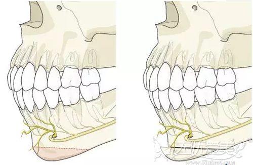 双鄂手术的效果
