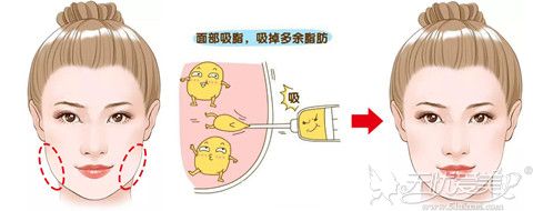 面部吸脂效果对比