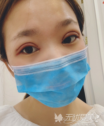 在北京做双眼皮+开眼角术后恢复