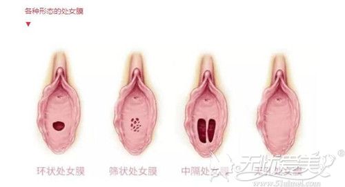 处女膜修复的几种形状