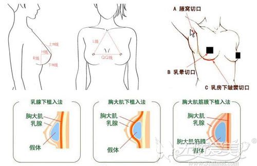 假体隆胸的切口位置
