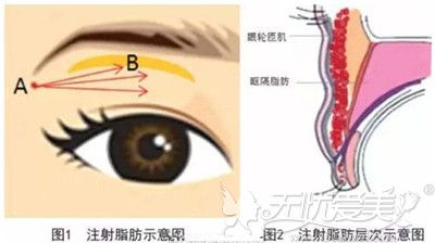 自体脂肪填充眼窝的层次