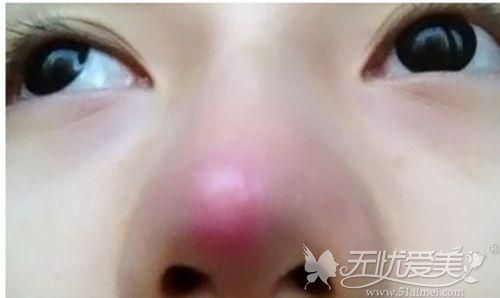 假体隆鼻后鼻尖发红找杭州李波医生做鼻修复即可改善