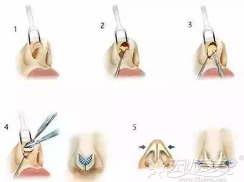 鼻修复手术过程