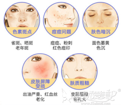 光子嫩肤可以改善皮肤问题