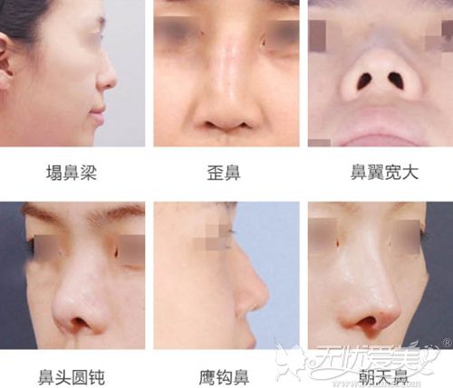 鼻综合手术可以改善的鼻子缺陷
