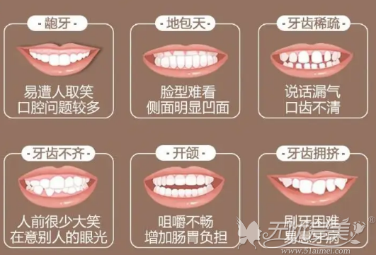隐形牙齿矫正可以改善牙齿类型