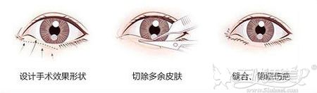 眼综合手术过程