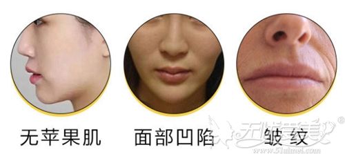 面部自体脂肪填充可以改善面部情况