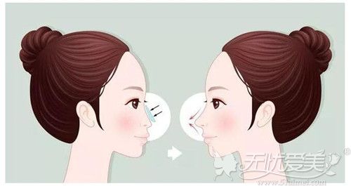 做的假体隆鼻手术不满意取出后鼻梁会变得扁更塌吗？