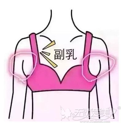 副乳抽脂后变得更丑了是你消除方法没做正确导致的