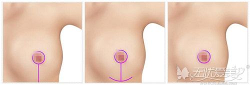 乳房缩小手术常见的手术切口