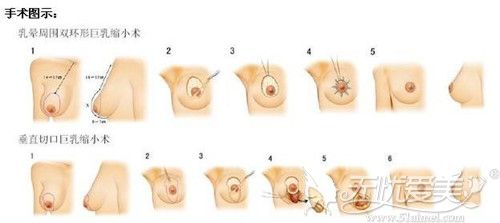 乳房缩小手术操作过程