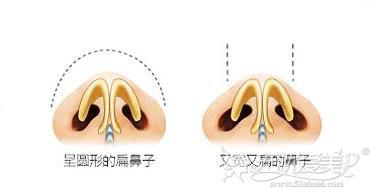 为了搞明白鼻翼肥大是什么原因导致的就去咨询了鼻翼缩小