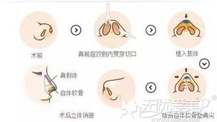 鼻综合整形手术过程