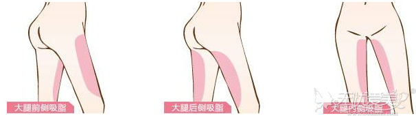 南京大腿吸脂手术部位