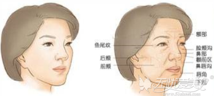 玻尿酸可以改善的面部问题