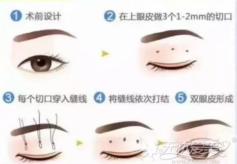 做双眼皮手术选择韩式三点和全切哪个好要看个人实际情况