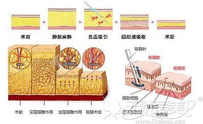 朋友说面部吸脂后特别后悔没有早点做，效果就这么好吗？