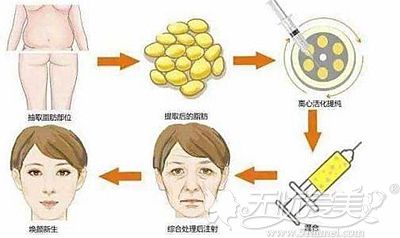 如果你想要让脸部脂肪填充后成活率高就要切记这几大禁忌