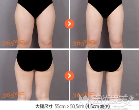 韩国大腿吸脂手术的案例